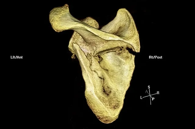 Prelom lopatice, CT rekonstrukcija