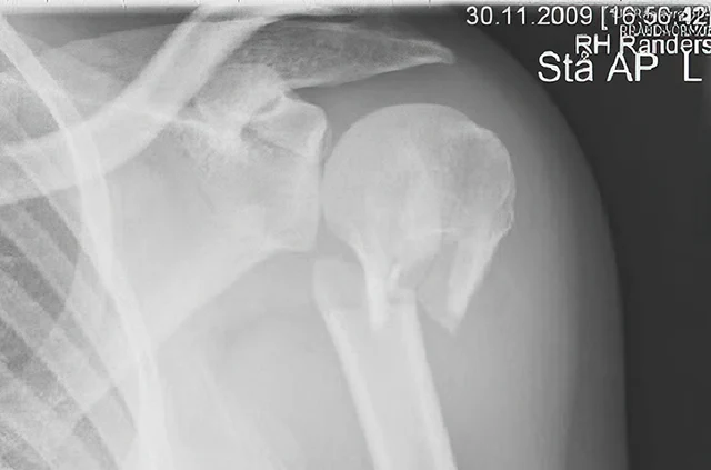 Prelom gornjeg okrajka nadlaktice (humerusa), rendgenski snimak