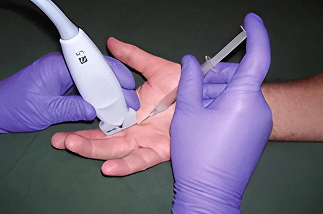 Ultrazvučno navođena blokada šake